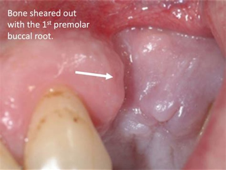 Can premolars be replaced?