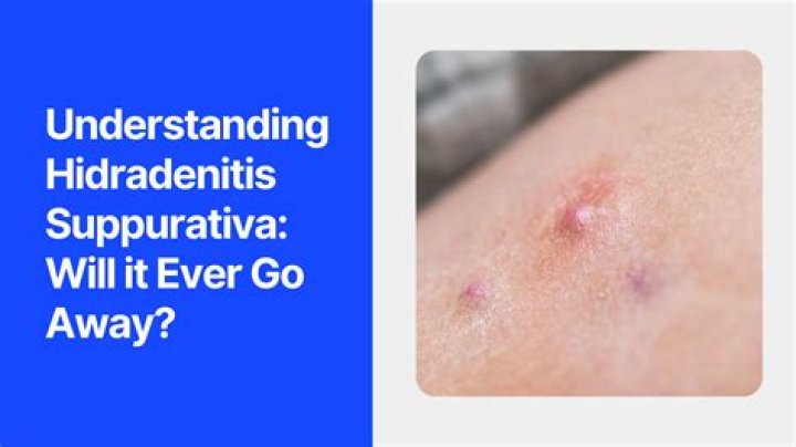 Does hidradenitis suppurativa go away?