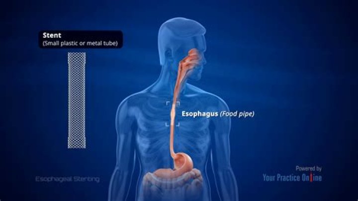 How long does an oesophageal stent last?