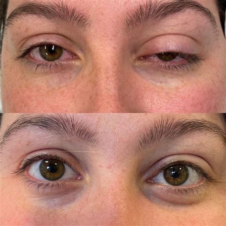 When does eyelid droop after botox?